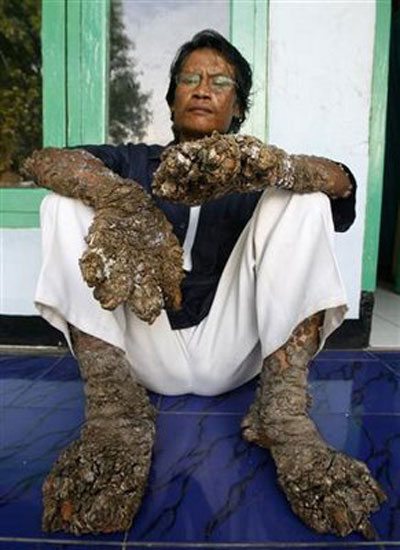 Homem Árvore - Uma Doença Hereditária e Cruel 