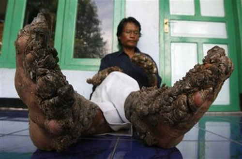 Homem Árvore - Uma Doença Hereditária e Cruel 