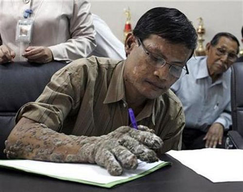 Homem Árvore - Uma Doença Hereditária e Cruel 