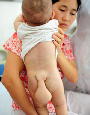 Mundo: Bebê chinês nasce com "cauda" de dez centímetros