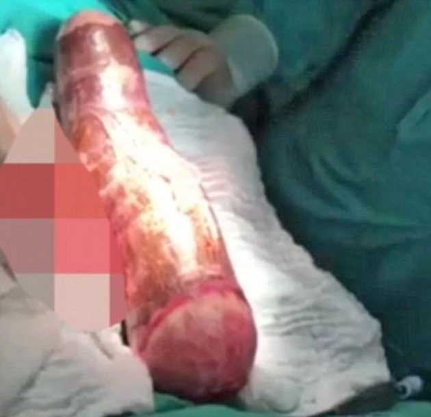 Homem passa por reconstrução do intestino após usar mandioca como brinquedo sexual